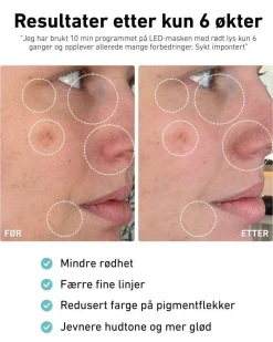 LED-lysmaske til ansikt mot akne, rynker og pigmentflekker