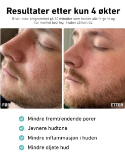LED-lysmaske til ansikt mot akne, rynker og pigmentflekker